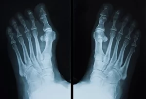 hallux valgus