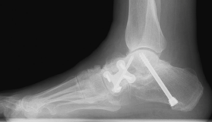 Flat foot
